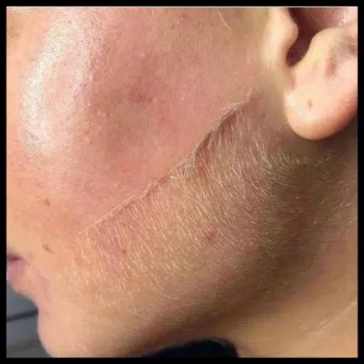 vellus hair